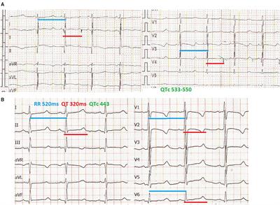 Mexiletine Treatment for Neonatal LQT3 Syndrome: Case Report and Literature Review